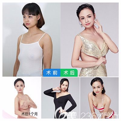 广州曙光吴毅平隆胸案例效果图