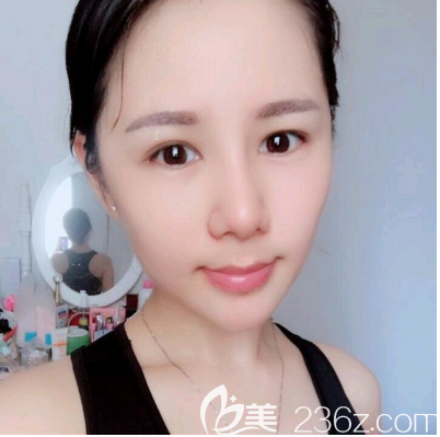 佛山华美雷朝勇肋软骨隆鼻案例