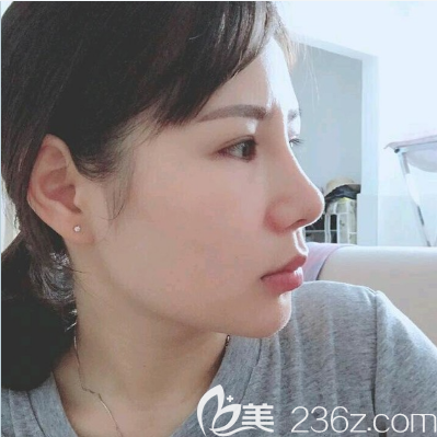 雷朝勇做的隆鼻案例一个月侧面效果图