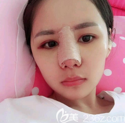 佛山华美肋软骨隆鼻术后天