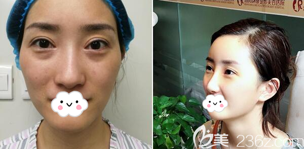 绵阳朗睿整形<!--<i data=20240703-sp></i>-->耳软骨隆鼻案