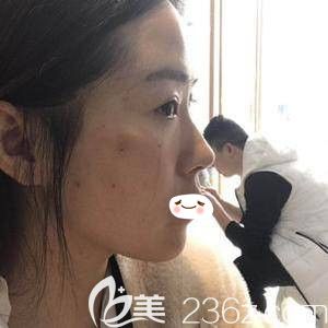 郑州华领全面部PPDO<span style= 郑州华领全面部PPDO<span style=