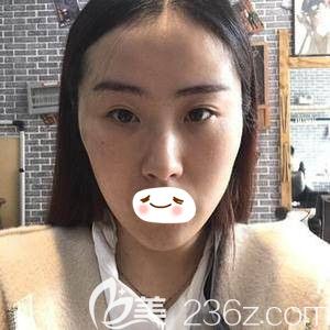 郑州华领全面部PPDO<span style= 郑州华领全面部PPDO<span style=