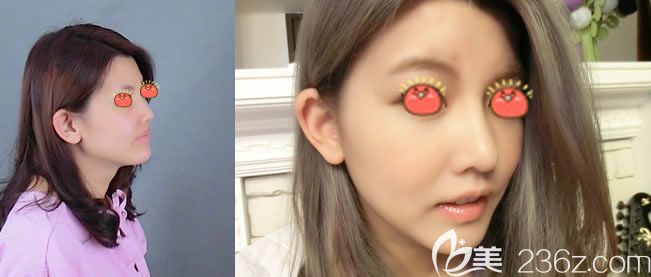 东阳丽莱杨建荣鼻综合隆鼻案例 东阳丽莱杨建荣鼻综合隆鼻案例