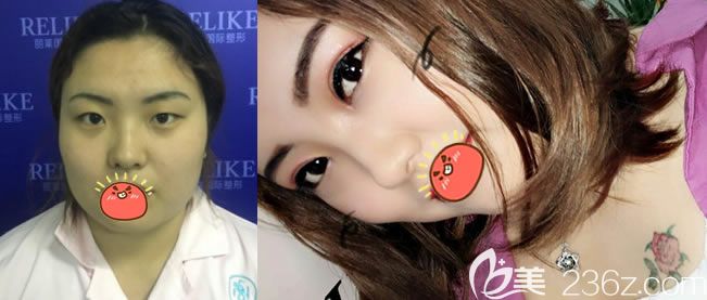 东阳丽莱<!--<i data=20240703-sp></i>-->割双眼皮和开眼角案例 东阳丽莱<!--<i data=20240703-sp></i>-->割双眼皮和开眼角案例