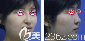 我在北京雅靓做鼻修复前样子 我在北京雅靓做鼻修复前样子