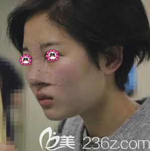 陈林叶医生给我鼻修复术后即刻样子 陈林叶医生给我鼻修复术后即刻样子