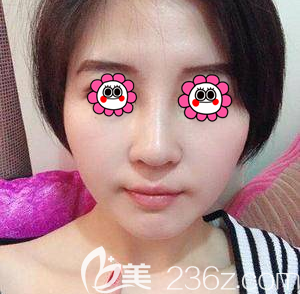 在北京雅靓做鼻修复第17天效果 在北京雅靓做鼻修复第17天效果