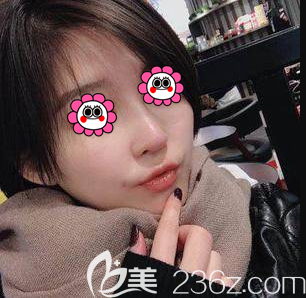 北京雅靓医疗美容诊所鼻修复案例