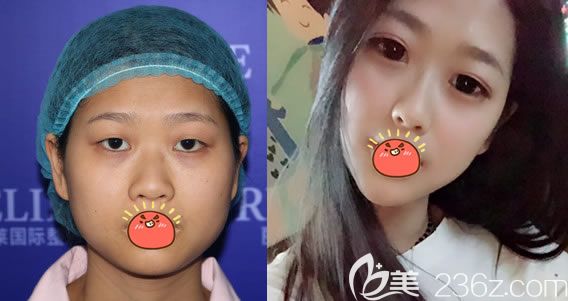 东阳丽莱杨建荣双眼皮开眼角案例