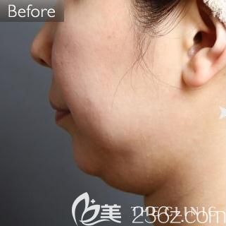 THE CLINIC大桥昌敬下巴吸脂前 THE CLINIC大桥昌敬下巴吸脂前