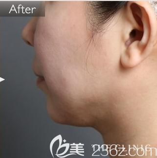 日本哪家医院做下巴吸脂更专业? THE CLINIC大桥昌敬成功帮我塑造童颜小V脸