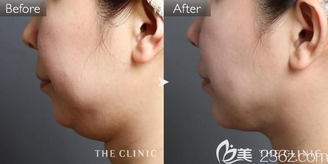 THE CLINIC大桥昌敬下巴吸脂前后对比 THE CLINIC大桥昌敬下巴吸脂前后对比