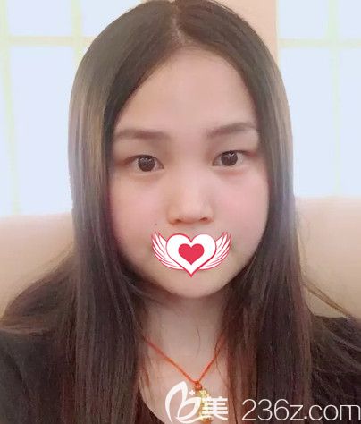 <!--<i data=20240703-sp></i>-->蔡鹏武医生为我做眼综合前是无神单眼皮 <!--<i data=20240703-sp></i>-->蔡鹏武医生为我做眼综合前是无神单眼皮