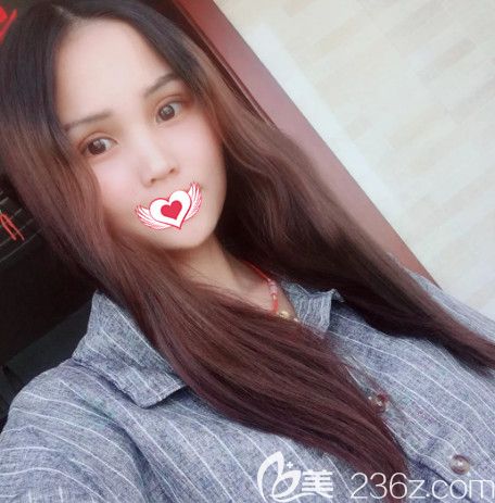 蔡鹏武医生做眼综合术后7天进行拆线 蔡鹏武医生做眼综合术后7天进行拆线