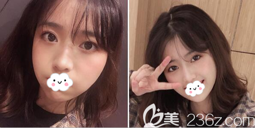 雷刚自体脂肪填充面部术后3个月恢复照片