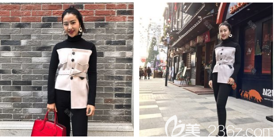 广州艺美宝丽太大腿吸脂10天消肿