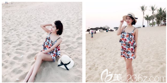 广州艺美张涛做的宝丽太大腿吸脂案例