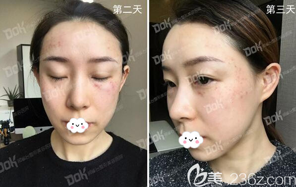 激光祛斑治疗术后恢复期图片