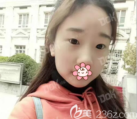 双眼皮术前眼睛无神眼距宽 双眼皮术前眼睛无神眼距宽