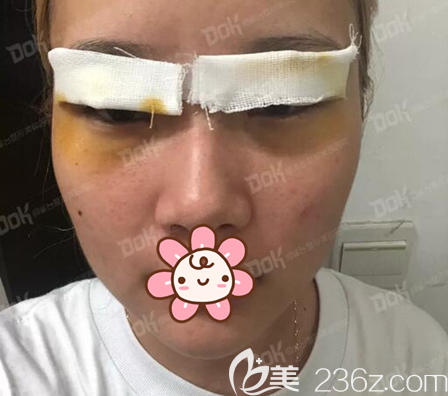 切开双眼皮+开眼角术后即刻 切开双眼皮+开眼角术后即刻