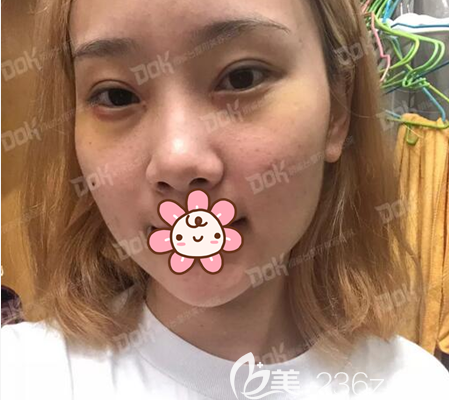 成都铜雀台双眼皮拆线后照片 成都铜雀台双眼皮拆线后照片