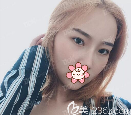 切开双眼皮+开眼角术后照片 切开双眼皮+开眼角术后照片