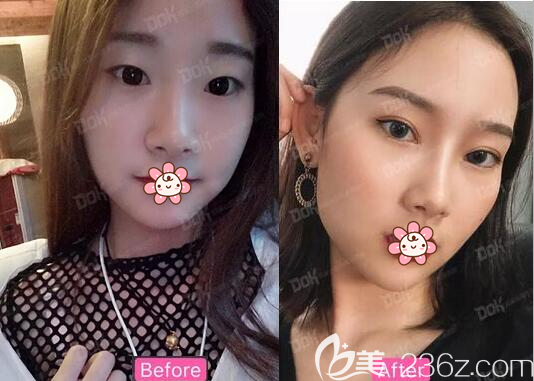 刘祎双眼皮开眼角手术前后对比 刘祎双眼皮开眼角手术前后对比