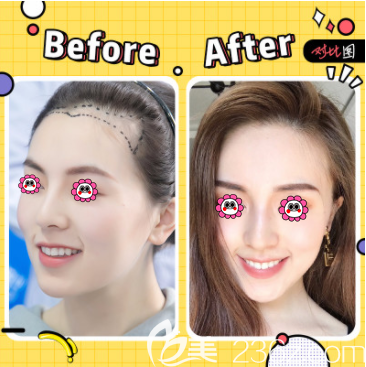 北京碧莲盛杨志祥医生发际线种植案例 北京碧莲盛杨志祥医生发际线种植案例