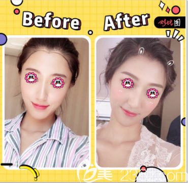 北京碧莲盛袁国安医生美人尖种植案例 北京碧莲盛袁国安医生美人尖种植案例