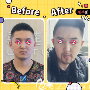 北京碧莲盛张鹏程医生胡须种植案例 北京碧莲盛张鹏程医生胡须种植案例