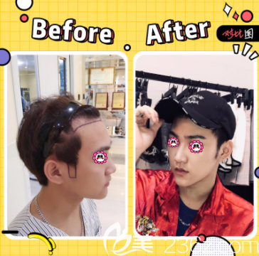 北京碧莲盛陈彪医生鬓角+发际线种植案例 北京碧莲盛陈彪医生鬓角+发际线种植案例