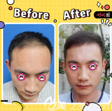 北京碧莲盛陈彪医生头顶加密种植案例