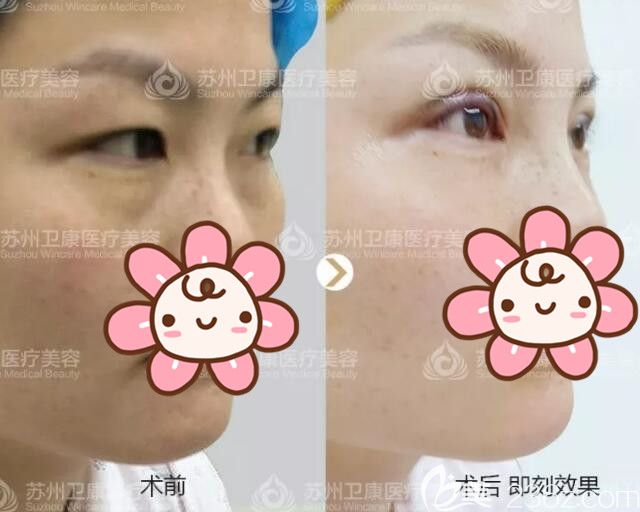 李景方医生刚做完双眼皮和术前对比