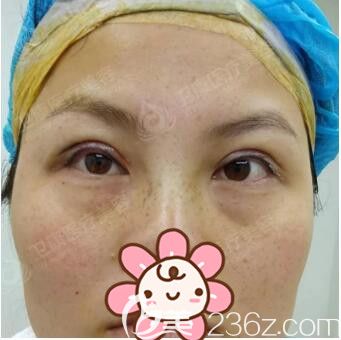 做完双眼皮去皮去脂第二天恢复