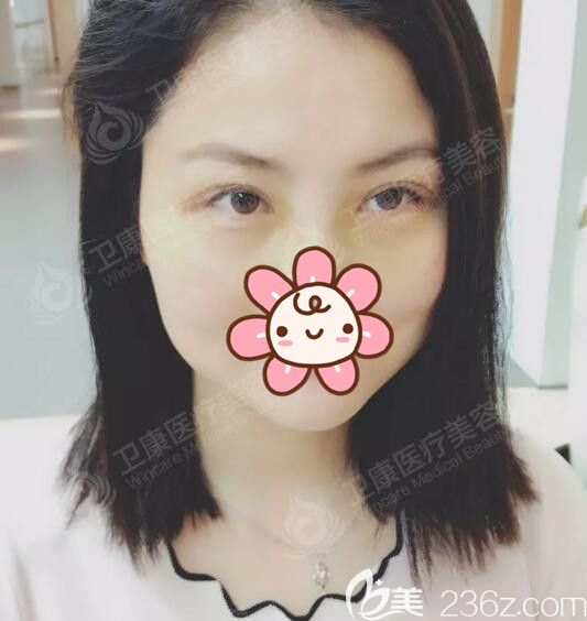 术后一周到苏州卫康拆线后双眼皮恢复