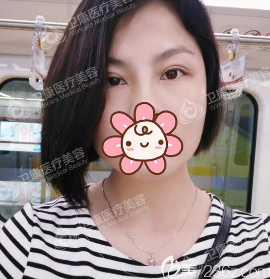 再三对比苏州有排名的整形医院后选定了苏州卫康李景方医生做双眼皮，8mm宽度很适合