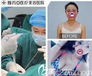 雅芳亚整形医院做隆胸案例 雅芳亚整形医院做隆胸案例