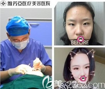 石家庄雅芳亚做双眼皮前后对比图 石家庄雅芳亚做双眼皮前后对比图