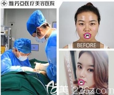 石家庄雅芳亚做隆鼻案例对比 石家庄雅芳亚做隆鼻案例对比