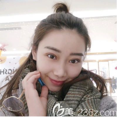 汕头华美双眼皮案例15天效果图