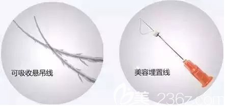 可吸收悬吊线和美容埋置线示意图