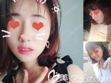 自体肋软骨+假体鼻综合术后15天<span style=