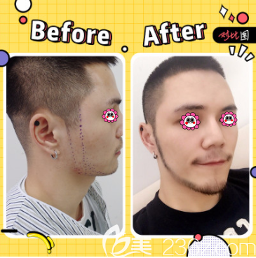 北京碧莲盛鲁少康医生络腮胡种植案例 北京碧莲盛鲁少康医生络腮胡种植案例