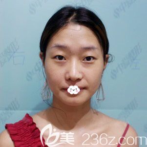 湖北黄石中爱整形美容医院万文勇双眼皮案例 湖北黄石中爱整形美容医院万文勇双眼皮案例