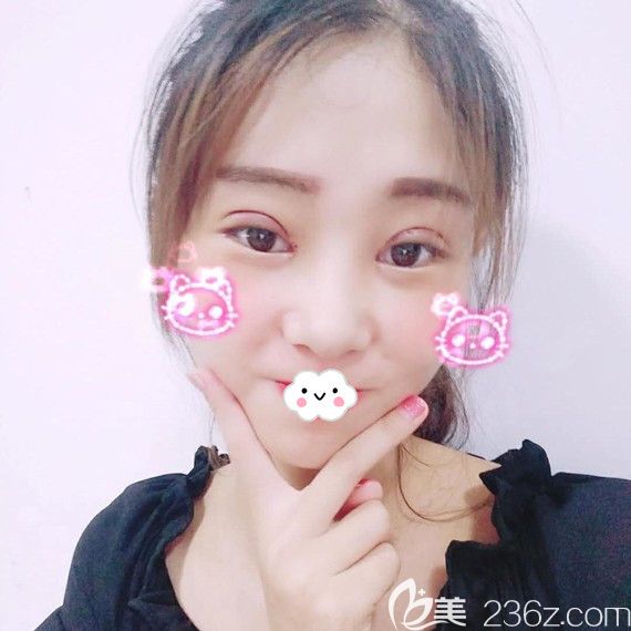 黄石中爱万文勇双眼皮+开内眼角术后效果 黄石中爱万文勇双眼皮+开内眼角术后效果