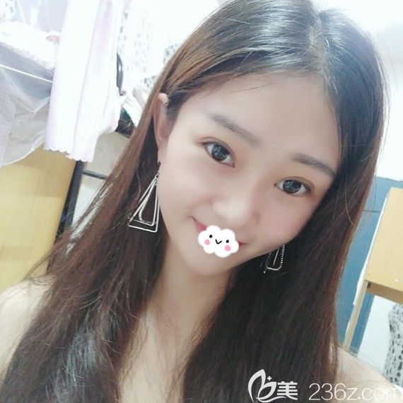 黄石中爱割双眼皮怎么样?万文勇眼综合案例 黄石中爱割双眼皮怎么样?万文勇眼综合案例