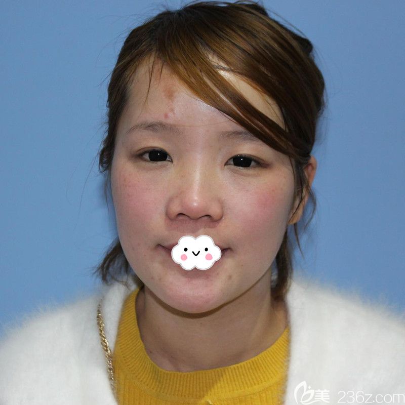 黄石中爱万文勇隆鼻真人案例 黄石中爱万文勇隆鼻真人案例