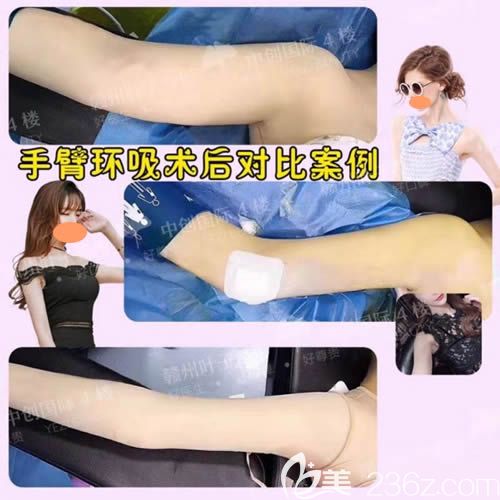 乐金堂吸脂瘦胳膊案例效果图