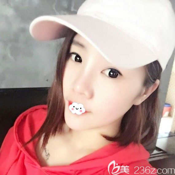 黄石中爱隆鼻效果怎么样?万文勇鼻综合案例 黄石中爱隆鼻效果怎么样?万文勇鼻综合案例